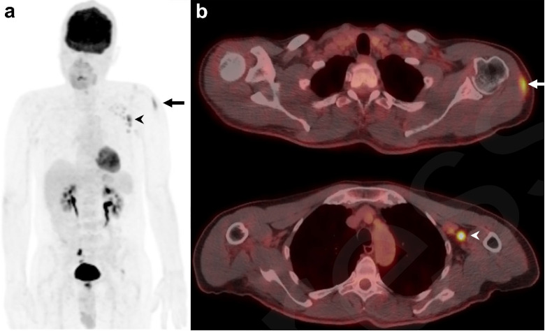 Example of a 60-year-old male patient on surveillance for smoldering myeloma with typical vaccination-associated findings. (a) Coronal maximum intensity projection (MIP) of 18F-FDG-PET and (b) fused axial 18F-FDG-PET/CT showing FDG avidity in the left deltoid muscle (SUVmax 5.9 g/ml) from the injection site (arrowhead) and ipsilateral reactive FDG-avid draining axillary lymph nodes (SUVmax 9.6 g/ml) (arrow), which are normal-sized on CT.