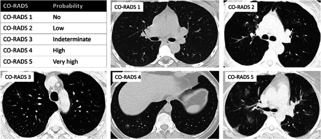 Illustration of CO-RADS scoring system for level of COVID-19 pneumonia suspicion. COVID-19 Reporting and Data System classification system (CO-RADS) scores the level of COVID-19 pneumonia suspicion as summarized in the upper left panel. The other panels show representative scans for CO-RADS 1 (no suspicion: normal findings), CO-RADS 2 (low level of suspicion: absence of ground glass opacities (GGO), presence of tree-in-bud signs/endobronchial spread/bronchiolitis), CO-RADS 3 (indeterminate: unifocal GGO), CO-RADS 4 (high level of suspicion: unilateral multifocal GGO) and CO-RADS 5 (very high level of suspicion: multifocal bilateral GGO).