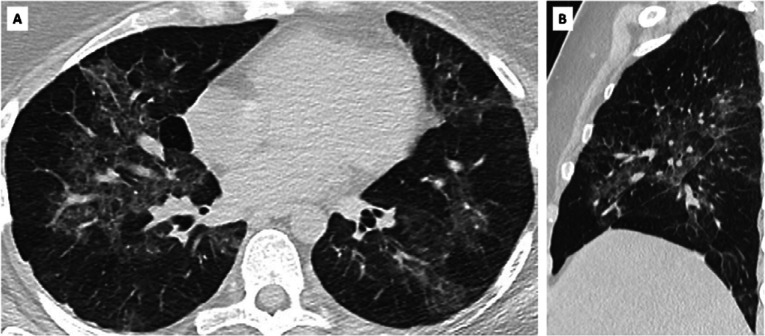 True positive CO-RADS 5 in SARS-CoV-2 PCR-positive asymptomatic individual. A, axial and, B, sagittal CT scan of asymptomatic individual with CO-RADS 5 and positive SARS-CoV-2 PCR. Clinical summary: a 31 year-old woman was admitted with diarrhea and left iliac fossa pain. She presented no respiratory symptoms, myalgia, loss of taste or smell or abnormal fatigue. Fever (39.4%) was attributed to suspected diverticulitis but a CT abdomen was negative. Standard chest CT scan as part of COVID-19 infection control policy showed multifocal bilateral ground glass opacities and crazy paving pattern, scored as CO-RADS 5. Blood testing showed increased CRP (48.4 mg/L), normal leukocyte count (6.8 x 10e3/μl) and no lymphocytopenia but increased D-dimers (1428 ng/mL) and increased LDH (669 U/L).