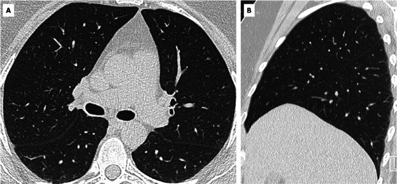 False negative CO-RADS 1 in SARS-CoV-2 PCR-positive symptomatic individual. A, axial and, B, sagittal CT scan of symptomatic individual with CO-RADS 1 and positive SARS-CoV-2 PCR test. Clinical summary: 57-year old woman presented headache, flu-like symptoms and dry cough for more than 10 days since returning from Hanoi, Vietnam. She was subfebrile and blood testing showed slightly increased CRP (5.3 mg/L), normal leukocyte count, no lymphocytopenia and normal D-dimers and LDH. Chest CT showed no abnormalities. PCR for Influenza A/B and RSV was negative but SARS-CoV-2 PCR was positive.