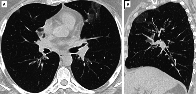 False positive CO-RADS 5 in SARS-CoV-2 PCR-negative symptomatic individual. A, axial and, B, sagittal CT scan of symptomatic individual with CO-RADS 5 but negative SARS-CoV-2 PCR test. Clinical summary: a 49 year old woman with medical history of haemochromatosis and psoriatic arthritis was admitted with wheezing, dry cough and increasing dyspnea since 2 weeks. She was subfebrile and hypoxic (89% SpO2). Blood testing showed increased CRP (32.8 mg/L) and leukocytosis with eosinophilia (1.1 x 10e3/µl). CT showed no pleural effusion but presence of multifocal bilateral ground glass opacities, scored as CO-RADS 5. SARS-CoV-2 PCR was repeatedly negative on nasopharyngeal swab. Extended syndromic PCR testing for 33 respiratory pathogens including 14 respiratory viruses was negative. Bronchoalveolar lavage was also repeatedly negative for SARS-CoV-2 PCR but showed high load of eosinophils (52 % of 65 x 10e4 nucleated cells/mL) supporting the diagnosis of acute eosinophilic pneumonia. The woman was successfully treated with corticosteroids.