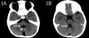 A three-year-old boy with a speech disorder and lifelong difficulty understanding simple instructions. A) A hypoplastic cerebellar vermis is evident on the axial CT image, with a midline fissure sign between the bilateral cerebellar hemispheres (short arrow), and a batwing sign on the fourth ventricle (long arrow). B) The upper cerebellar peduncles are thickened and elongated, forming a molar sign (arrow) with the midbrain