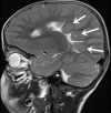 A three-year-old male toddler with difficulty walking unassisted, poor verbal skills, and developmental delays. A sagittal T2WI scan revealed the absence of the body and splenium of the corpus callosum, and the gray matter heterotopia (arrows)