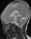A male infant, aged two months, presented with hoarseness for one day and head shaking for half a day. The sagittal T2WI revealed slight thinning of the midbrain, slight enlargement of the interpeduncular fossa, and thickening and elongation of the upper cerebellar peduncle, which was running horizontally (indicated by arrow)