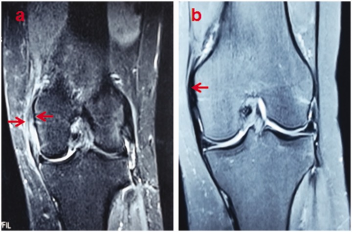 Autologous Platelet-rich Plasma Therapy For Refractory Pain After Low 