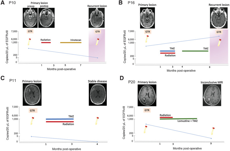 Figure 5. Detection of EGFRvIII mutation using optimized plasma-based assay in patients with different clinical outcomes. A, EGFRvIII mutation (copies/20 μL) in serial plasma samples obtained from four glioma patients are plotted against time (months postoperatively). Patient cases represent different clinical outcomes: recurrent disease (A and B), stable disease (C), and inconclusive MRI (D), that is, inability to clearly delineate pseudo-progression from true tumor progression. T1-weighted, contrast-enhanced MRI images are provided for different clinical timepoints. Surgical procedures are indicated using an orange square (GTR = gross total resection). Disease progression (tumor recurrence) is indicated using a pink background. Treatment courses for each patient are outlined.