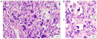 Figure 6. Histopathological images of PL. PL demonstrating (A) spindle to epitheloid pleomorphic cells, (B) pleomorphic lipoblasts with vacuolated cytoplasm and (C) other features of pleomorphic lipob...