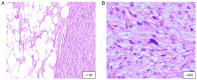 Figure 2. Histopathological images of DDL. (A) DDL including a well–differentiated adipose tissue component mixed with non–lipogenic elements, such as (B) a fibrosarcomatous component. Hematoxylin and...
