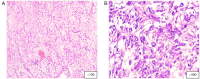 Figure 4. Histopathological images of ML. (A) ML comprising non–lipogenic mesenchymal cells with distinct myxoid background and a chicken wire vasculature, and (B) a high–grade ML, exhibiting a >5% ro...