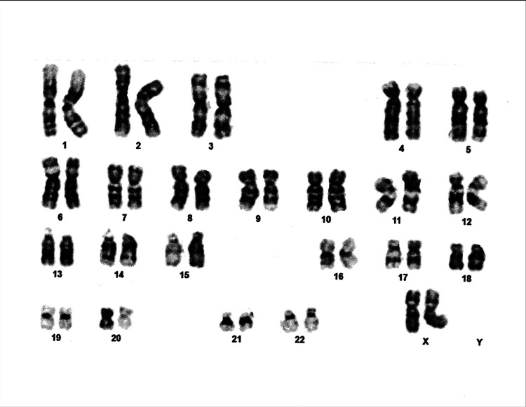 Xx male early detection with prenatal testing pmc
