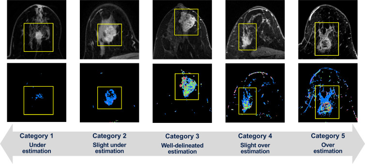 Within bounding boxes (yellow line), tumors on early postcontrast-phase axial MR images (top) and corresponding functional tumor volume (FTV) estimation on signal enhancement ratio (SER) maps (bottom) show the variation in FTV estimation as visually assessed using five categories, with representative cases of each category shown. The SER maps are colored as follows: red, SER >1.1 (washout); green, 0.9 ≤ SER ≤ 1.1 (plateau); blue, SER <0.9 (persistent).