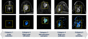 Within bounding boxes (yellow line), tumors on early
postcontrast-phase axial MR images (top) and corresponding functional tumor
volume (FTV) estimation on signal enhancement ratio (SER) maps (bottom) show
the variation in FTV estimation as visually assessed using five categories,
with representative cases of each category shown. The SER maps are colored
as follows: red, SER >1.1 (washout); green, 0.9 ≤ SER ≤
1.1 (plateau); blue, SER <0.9 (persistent).