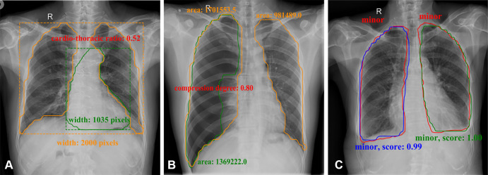 Semiquantitative analysis results for (A) cardiomegaly (orange contours were predicted lung masks and green contour was predicted heart boundary; these were used to calculate the cardiothoracic ratio), (B) pneumothorax (orange contours were predicted lung masks and green contour was predicted lung masks with lung texture; these were used to calculate the area compression degree), and (C) pleural effusion in frontal chest radiographs (red contours were ground truth and others were outputs of the model; these were used to calculate effusion level and confidence score).