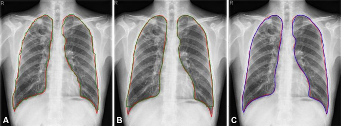 Results of Mask region-based convolutional neural network Point-based Rendering (R-CNNPointRend) and Mask R-CNN compared with U-Net for lung segmentation. Red contours were ground truth. Predictions from (A) Mask R-CNN (green line), (B) Mask R-CNNPointRend (green line), and (C) U-Net (blue line).