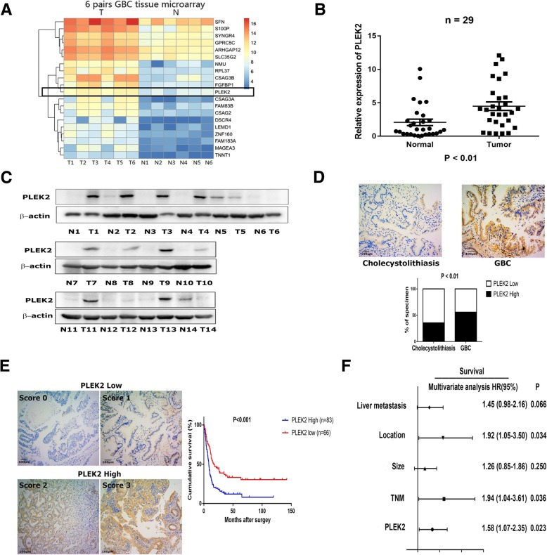 PLEK2 promotes gallbladder cancer invasion and metastasis through EGFR ...