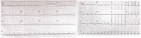 12-lead ECGs showing AFL with flutter waves and post cardioversion sinus tachycardia.