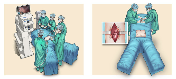 Transcervical versus transthoracic minimally invasive esophagectomy: a ...