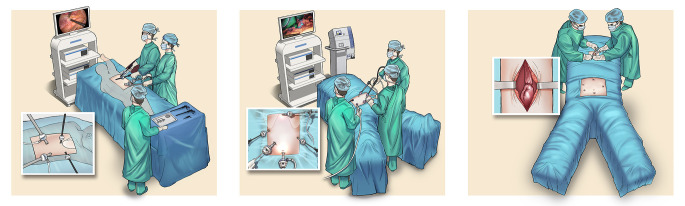 Transcervical versus transthoracic minimally invasive esophagectomy: a ...