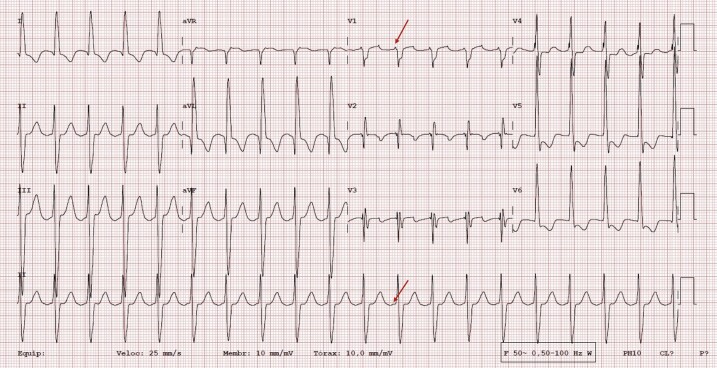 Case Report Of A Double wave Re entry Atrial Flutter In A Patient With case-report-of-a-double-wave-re-entry-atrial-flutter-in-a-patient-with