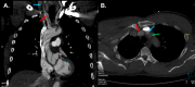 Supra-aortic vessel dissection