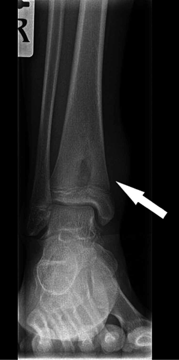 Brodie's Abscess: A Diagnostic Conundrum - PMC