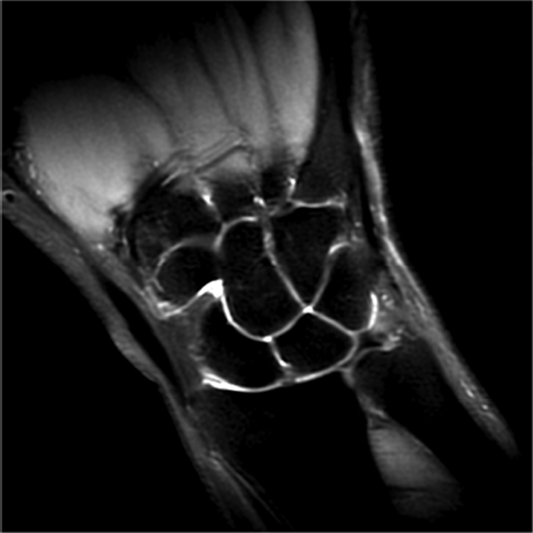 Approach to MRI of the Elbow and Wrist: Technical Aspects and ...