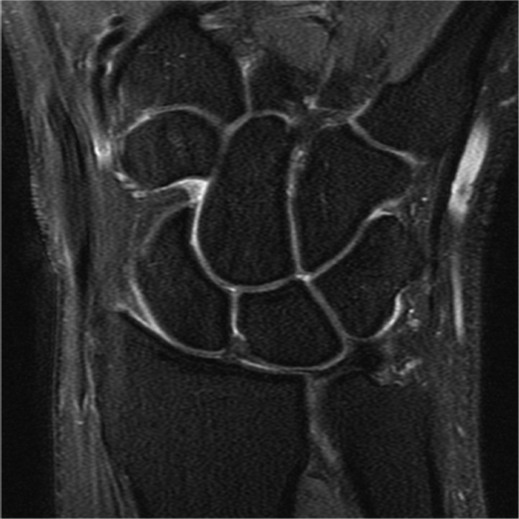 Approach to MRI of the Elbow and Wrist: Technical Aspects and ...