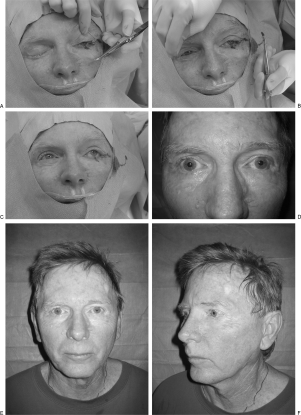 Reconstruction of the Eyelids after Mohs Surgery - PMC