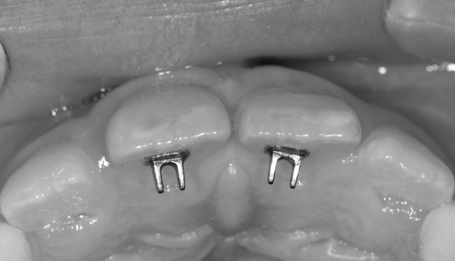 Figure 2. Lingual spurs used in the study.