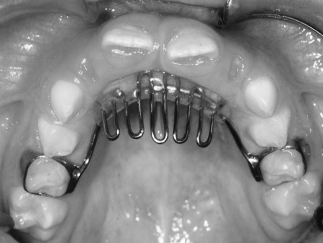 Figure 1. Model of palatal crib used in the study.