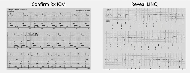 Accuracy of arrhythmia detection in implantable cardiac monitors: A ...