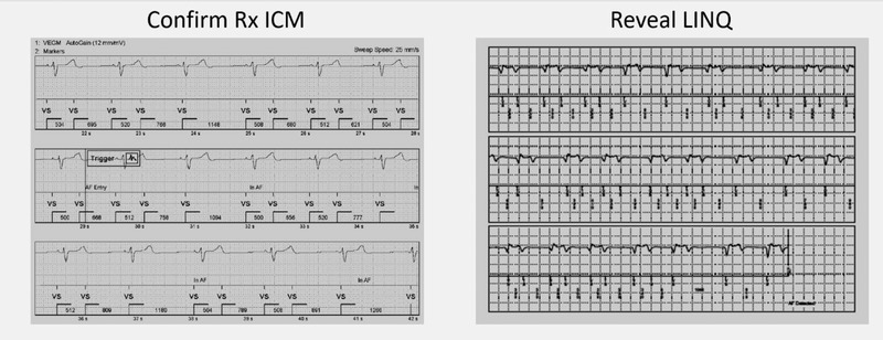 Accuracy of arrhythmia detection in implantable cardiac monitors: A ...