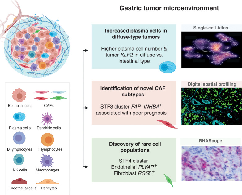 Figure 6. Comprehensive single-cell atlas of gastric cancer. This study included more than 200,000 cells from 31 primary gastric tumor samples. In total, 34 distinct cell-lineage states were identified, related by developmental trajectories and previously unreported rare cell populations. An increase in plasma cell proportions was observed as a feature of diffuse-type tumors associated with epithelial-resident KLF2. A stage-wise accrual of novel cancer-associated fibroblast subpopulations was marked by high INHBA and FAP coexpression. Findings were complemented using digital spatial transcriptomics and RNAScope. Our results provide a high-resolution molecular resource for gastric cancer translational studies, identifying intra- and interpatient lineage states across distinct gastric cancer subtypes.