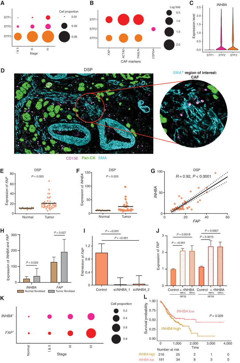 Figure 4. scRNA-seq enables identification of distinct gastric cancer fibroblast subtypes and INHBA–FAP axis as a CAF regulator. A, Bubble plots demonstrating stage-dependent increases in the proportion of fibroblast cells with STF3 being the dominant subcluster. The size of the circle represents the proportion of cells expressing subcluster-specific genes. B, Bubble plots showing fibroblast subclusters (STF1–3) expressing distinct CAF canonical markers (FAP, CSPG4, ACTA2, and TAGLN). The size of the circle represents the proportion of cells expressing different genes. C, Violin plot showing the expression of INHBA in STF2 and STF3 fibroblast clusters with negligible expression in the STF1 fibroblast cluster. D, Fibroblast ROIs captured by DSP analysis based on immunofluorescence staining for Pan-CK (epithelial, green), CD138 (plasma, pink), SMA (fibroblast, cyan), and DAPI (blue). The circular ROI is 300 μm in diameter. E, Bee swarm plot showing differential expression of FAP in fibroblast ROIs of normal and tumor samples by DSP (n = 13). F, Bee swarm plot showing differential expression of INHBA in fibroblast ROIs of normal and tumor samples by DSP (n = 13). G, Pearson correlation graph demonstrating strong positive correlations between INHBA and FAP gene expression in fibroblast ROIs using DSP. H, Bar graph showing significant expression of FAP and INHBA genes in flow-sorted tumor fibroblasts compared with matched normal fibroblasts (n = 10 each). I, Bar graph showing significant reduction in FAP gene expression after siRNA-mediated INHBA knockdown in tumor fibroblast lines. Two independent siRNAs were used. J, Bar graph showing significant increases in FAP gene expression in two normal fibroblast lines after treatment with recombinant INHBA (rINHBA) for 48 and 96 hours, respectively. K, Bubble plot depicting stage-dependent increases of FAP+ and INHBA+ cells in fibroblast cluster STF3 (P = 0.041). The circle sizes represent the relative proportion of cells expressing these genes. P values were computed using Kendall's τ method. L, Kaplan–Meier survival curves of TCGA-STAD data showing significant differences in overall survival between INHBA-high and INHBA-low samples. P values were computed using log-rank tests.