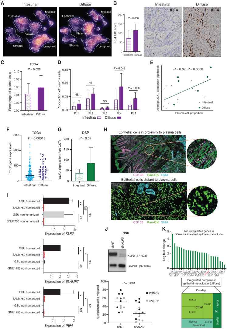 Figure 3. Differential TME analysis between histologic subtypes identifies increased plasma cells in diffuse-type tumors. A, Density plot of UMAP representation comparing diffuse and intestinal gastric cancer samples after random downsampling to approximately 25,000 cells each. Each dot represents a single cell. Dashed lines highlight a higher proportion of plasma cells in diffuse gastric cancer. B, IHC staining of IRF4 expression in diffuse (n = 5) and intestinal (n = 12) gastric cancer samples (scale bar, 400 μm). Bar graph showing significantly higher average IRF4 IHC score in diffuse compared with intestinal gastric cancer. C, Plasma cell proportions deconvoluted by CIBERSORTX in diffuse and intestinal gastric cancer in the TCGA data set (diffuse n = 63; intestinal n = 167). D, Bar graph showing enrichment of plasma cell proportions in PL4 and PL5 plasma subclusters in diffuse versus intestinal gastric cancer single-cell samples. E, Pearson correlation plot showing significant positive correlation of plasma cell proportion to average KLF2 expression in the epithelial metacluster. F, Bee swarm plot showing increased KLF2 expression in diffuse versus intestinal gastric cancer samples in the bulk RNA-seq TCGA-STAD data set. G, Bar graph showing increased KLF2 expression in Pan-CK+ epithelial morphologic regions of diffuse versus intestinal gastric cancer by DSP (n = 10). H, DSP analysis depicting epithelial ROIs proximal (top) and distal to plasma cells (bottom). Analysis is based on immunofluorescence staining for Pan-CK (epithelial, green), CD138 (plasma, pink), smooth muscle actin (SMA; fibroblast, cyan), and DAPI (blue). Each circular ROI is 300 μm in diameter. I, Bar graph showing expression of KLF2, IRF4, and SLAMF7 genes in GSU humanized and nonhumanized mice against SNU1750 humanized and nonhumanized mice. *, P < 0.05; **, P < 0.01. J, Western blot (top) showing stable knockdown of KLF2 in gastric cancer cell line GSU (shKLF2) compared with shNT (nontargeting) control. Loss of KLF2 in GSU significantly reduces migration of plasma cells derived from peripheral blood mononuclear cells (PBMC) and multiple myeloma cell line KMS-11 (N = 17; bottom). K, Upregulation of immunoglobulin genes in diffuse versus intestinal epithelial metacluster (top). Tree map shows the overlap of upregulated pathways in epithelial metacluster versus subclusters, with the EpiC cluster showing the greatest overlap (bottom).