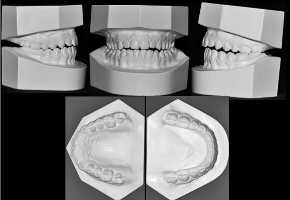 Figure 1. Dental cast photographs.