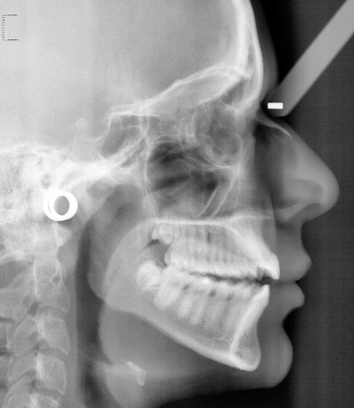 Figure 2. Digital lateral cephalometric radiography.