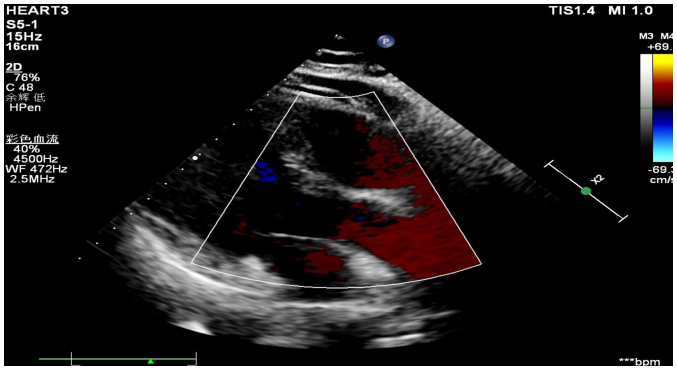 Cushing's Syndrome Caused By Adrenocortical Oncocytoma: A Case Report - Pmc