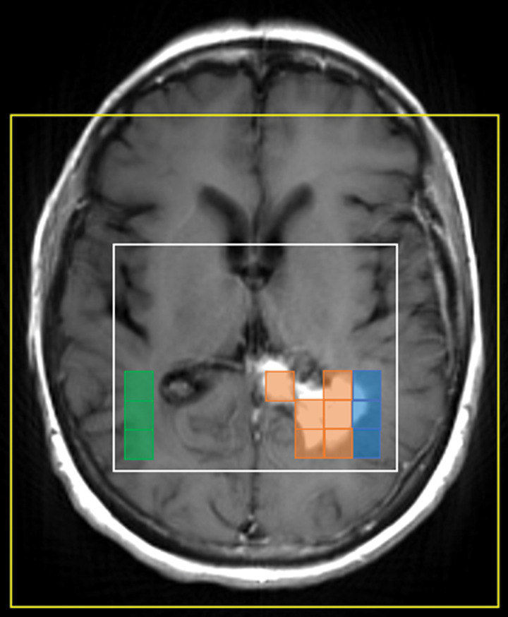 MRSI voxel selection. Based on T1-weighted postcontrast MRI, intratumoral (orange), peritumoral (blue), and contralateral (green) voxels were selected for further analysis. The surrounding white box represents the excitation volume, and the yellow box denotes the field of view.