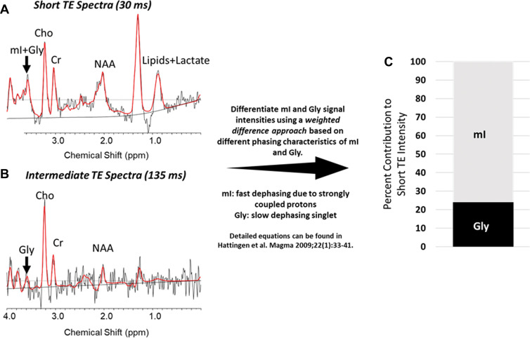 Differentiating between glycine (Gly) and myo-inositol (mI) signal intensities at short echo time (TE). (A, B) For a sample intratumoral voxel, we used multiecho MR spectroscopic imaging data and performed a weighted calculation to distinguish between mI and Gly contributions to short TE signal intensities. Graphs show these results, with peaks indicated for mI plus Gly (or Gly alone), choline (Cho), creatine (Cr), N-acetylaspartate (NAA), and lipids plus lactate (in A only). The real part of the frequency-domain data is plotted as a thin curve. The thick red curve is the LCModel fit to this data. Also plotted as a thin curve is the baseline. ppm = parts per million. (C) Bar graph shows the contribution of mI and Gly to the full signal. In this example, the true mI contribution is 76% of the signal.