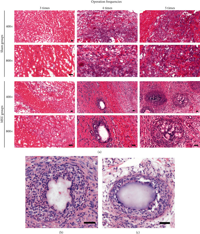 Minimally invasive embedding of saturated msu induces persistent gouty