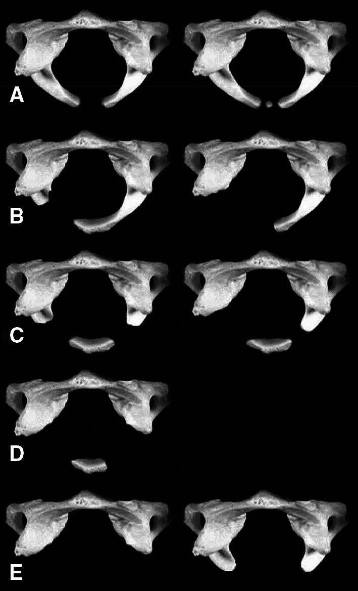 Congenital C1 arch deficiency: Grand Round presentation - PMC