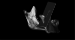 Figure 4. Plane passing tangent to the distal slope of the coronoid process.