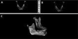Figure 3. Superimposition points (foramen mentale and antegonial notch) marked on (A) pretreatment and (B) posttreatment images. (C) Superimposition of images.