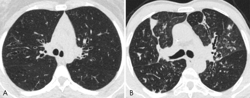 A, The calculated value for the Nkam score was 0.5 in this 20-year-old patient with cystic fibrosis. Using CT images, the radiomics approach predicted a Nkam score value of 0.35 with LASSO and 0.30 with the ensemble of decision trees. B, By comparison, the calculated value for the Nkam score was 3 in this 48-year-old patient with cystic fibrosis. Using CT images, the radiomics approach predicted a Nkam score value of 2.96 with LASSO and 2.11 with the ensemble of decision trees.