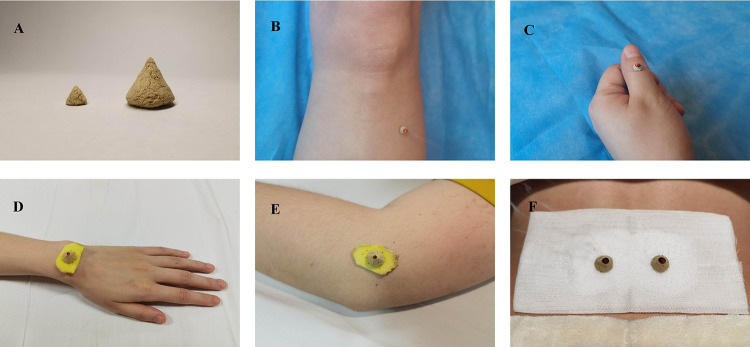 The Effects and Potential Mechanisms of Moxibustion for Rheumatoid ...