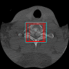 Axial noncontrast cervical spine CT image with bounding boxes surrounding
the fractured vertebrae, annotated by individual neuroradiologists (red). Ground
truth bounding box (cyan) was calculated by taking the largest sum of all
individual bounding boxes, representing the largest bounding box.