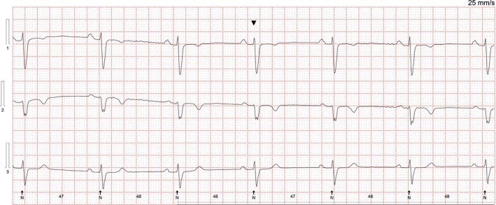 Pacing spikes following QRS complexes: What is the mechanism? - PMC