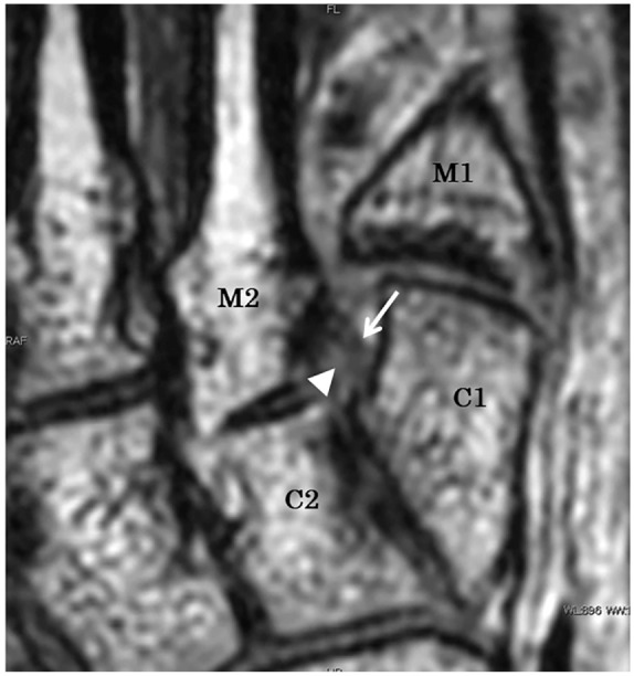 The Diagnostic Accuracy of MRI to Evaluate Acute Lisfranc Joint ...