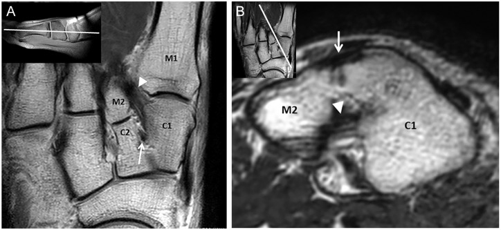 The Diagnostic Accuracy of MRI to Evaluate Acute Lisfranc Joint ...